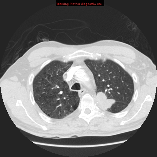 File:Bronchogenic carcinoma brain metastasis (Radiopaedia 9286-105832 Axial lung window 21).jpg