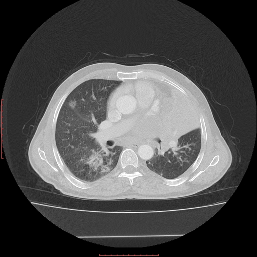 File:Bronchogenic carcinoma with left atrial large deposit - T4N3M1a (Radiopaedia 42316-45428 Axial lung window 15).jpg
