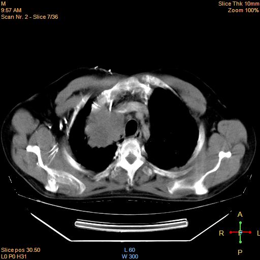 File:Bronchogenic carcinoma with superior vena caval invasion (Radiopaedia 22378-22406 Axial liver window 5).jpg