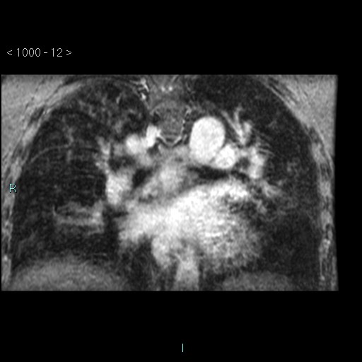 File:Bronchogenic cyst - posterior mediastinal (Radiopaedia 43885-47365 Coronal T1 C+ 11).jpg