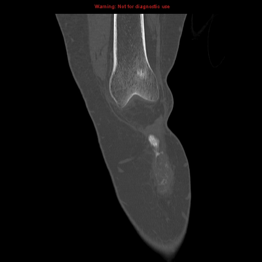 File:Brown tumors (Radiopaedia 9666-10291 Coronal bone window 4).jpg