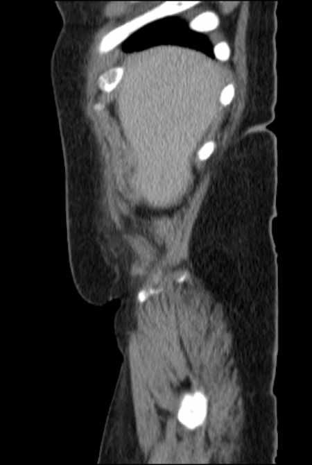 Brown tumors compressing the spinal cord (Radiopaedia 68442-77988 F 7).jpg