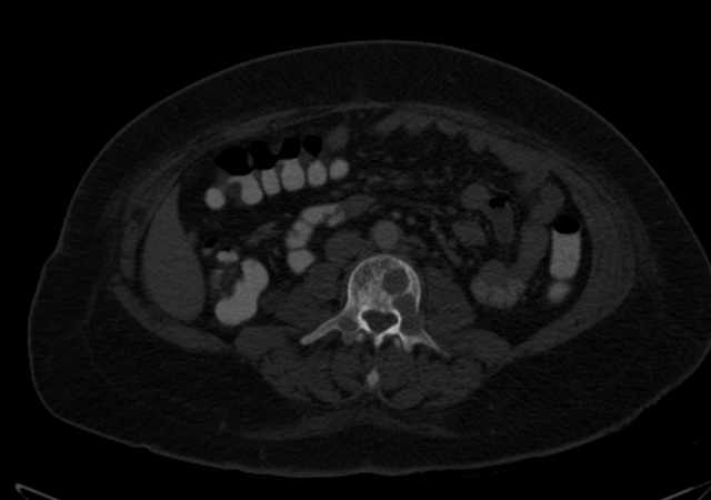Brown tumors compressing the spinal cord (Radiopaedia 68442-77988 G 66).jpg