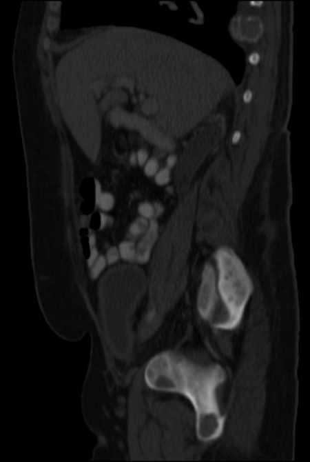 Brown tumors compressing the spinal cord (Radiopaedia 68442-77988 H 21).jpg