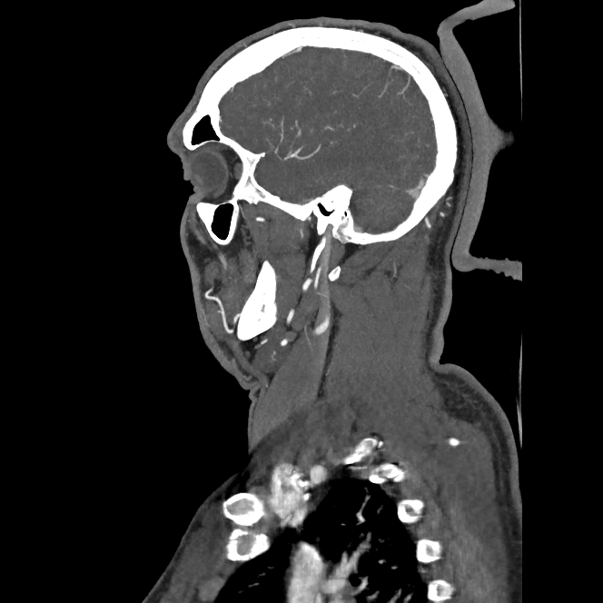 Buccal fat pad arteriovenous malformation (Radiopaedia 70936-81144 C 59).jpg