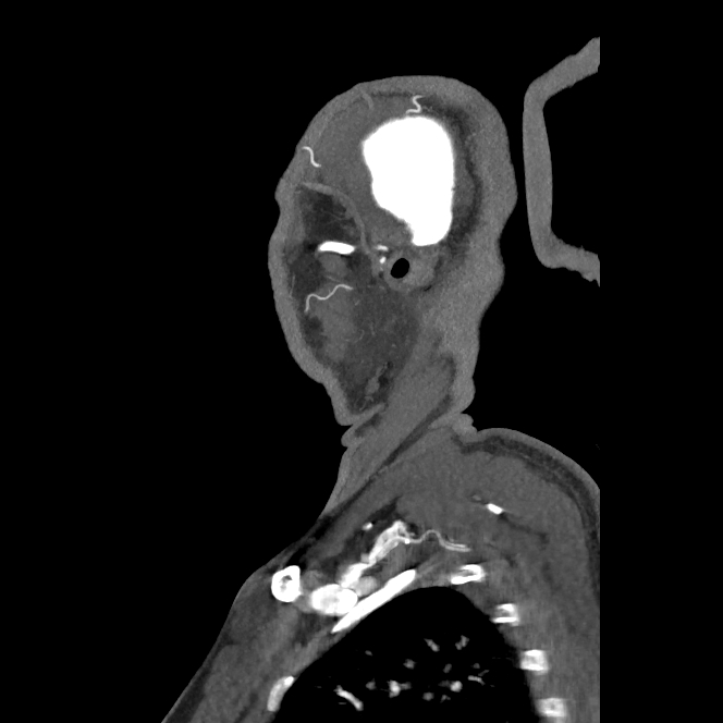 Buccal fat pad arteriovenous malformation (Radiopaedia 70936-81144 C 69).jpg