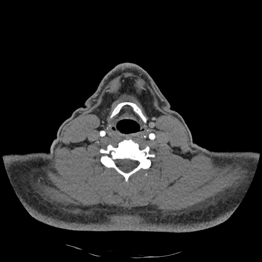 Buccal fat pad arteriovenous malformation (Radiopaedia 70936-81144 D 119).jpg