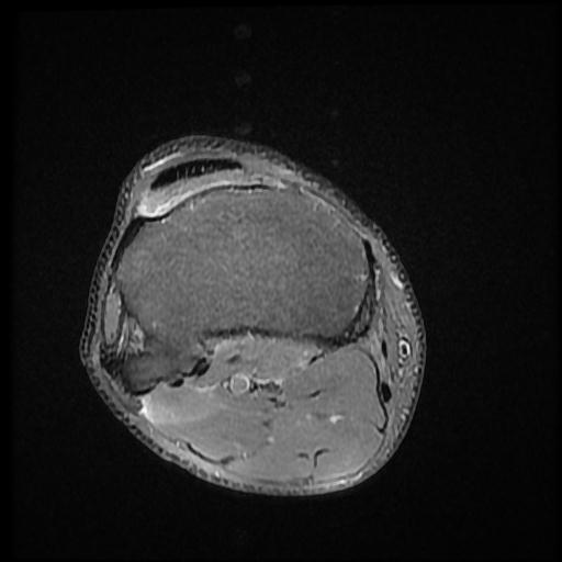 File:Bucket handle tear - medial meniscus (Radiopaedia 69245-79026 Axial PD fat sat 17).jpg