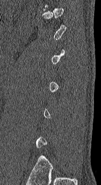 Burst fracture (Radiopaedia 53373-59357 Sagittal bone window 6).jpg