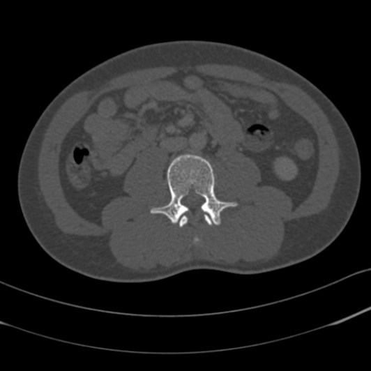 Burst fracture with cauda equina syndrome (Radiopaedia 25701-25867 Axial bone window 89).jpg