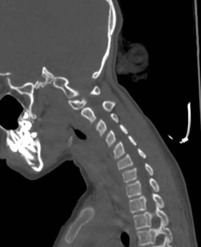 Butterfly vertebra (Radiopaedia 77903-90209 Sagittal bone window 66).jpg