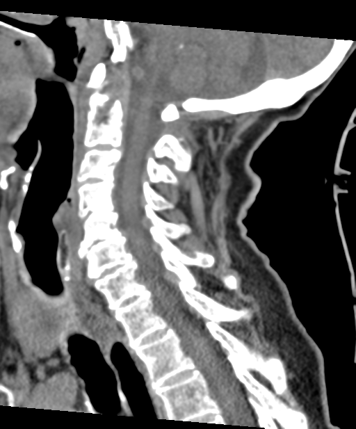 C2 fracture with vertebral artery dissection (Radiopaedia 37378-39199 D 37).png