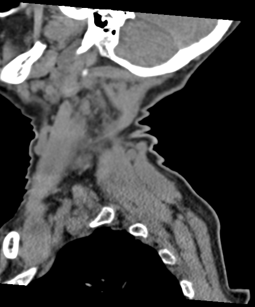 C2 fracture with vertebral artery dissection (Radiopaedia 37378-39199 D 68).png