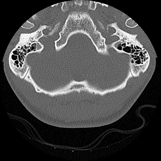 File:C5 facet fracture (Radiopaedia 58374-65499 Axial bone window 2).jpg