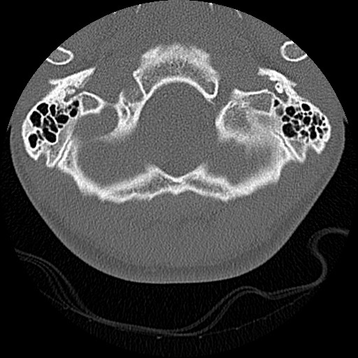 File:C5 facet fracture (Radiopaedia 58374-65499 Axial bone window 4).jpg