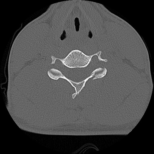 File:C5 facet fracture (Radiopaedia 58374-65499 Axial bone window 55).jpg