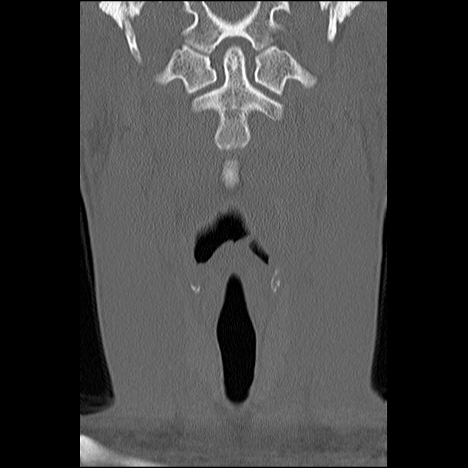 C5 facet fracture (Radiopaedia 58374-65499 Coronal bone window 18).jpg