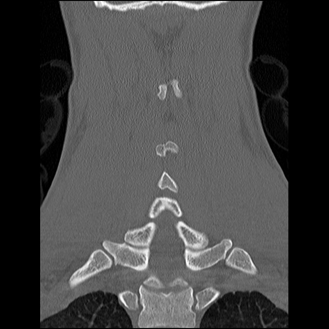 C5 facet fracture (Radiopaedia 58374-65499 Coronal bone window 42).jpg
