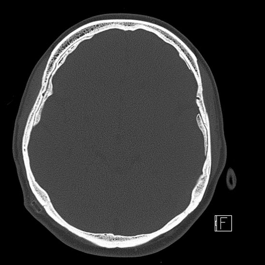 Calcified chronic subdural hematoma (Radiopaedia 77374-89492 Axial bone window 53).jpg