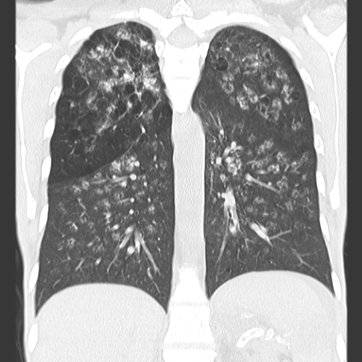 File:Calciphylaxis and metastatic pulmonary calcification (Radiopaedia 10887-11318 Coronal lung window 11).jpg