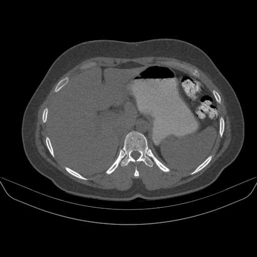 File:Calcium milk gallbladder (Radiopaedia 61050-68907 Axial bone window 58).jpg