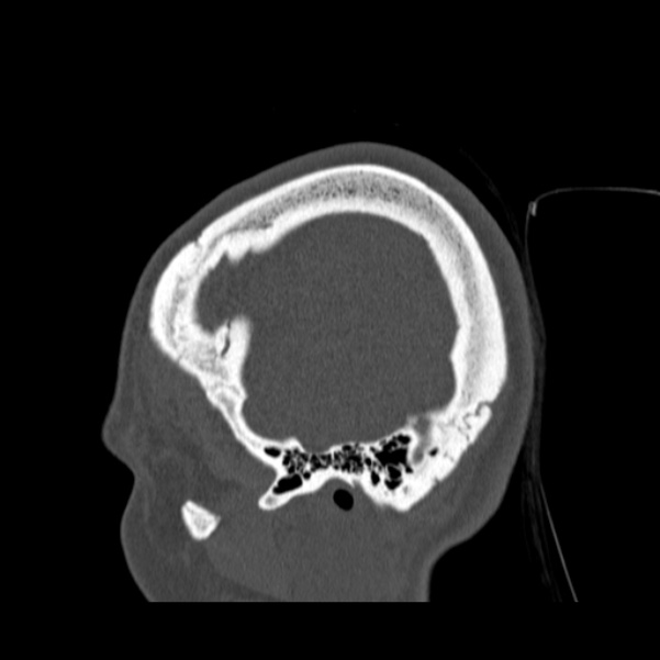 Calvarial osteoma (Radiopaedia 36520-38079 Sagittal bone window 94).jpg