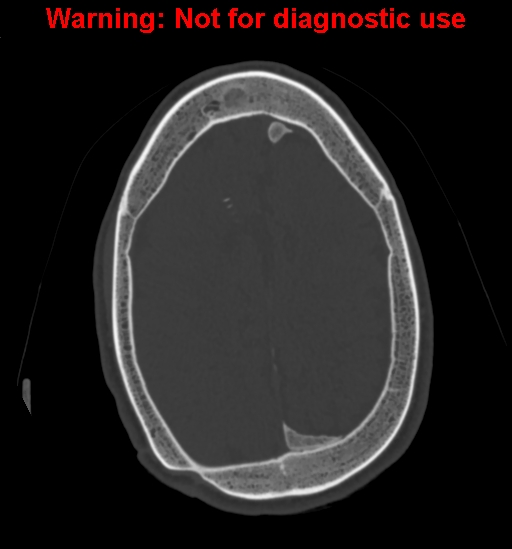 Calvarial thickening from chronic shunting (Radiopaedia 60079-67637 Axial bone window 134).jpg