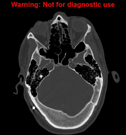 Calvarial thickening from chronic shunting (Radiopaedia 60079-67637 Axial bone window 51).jpg