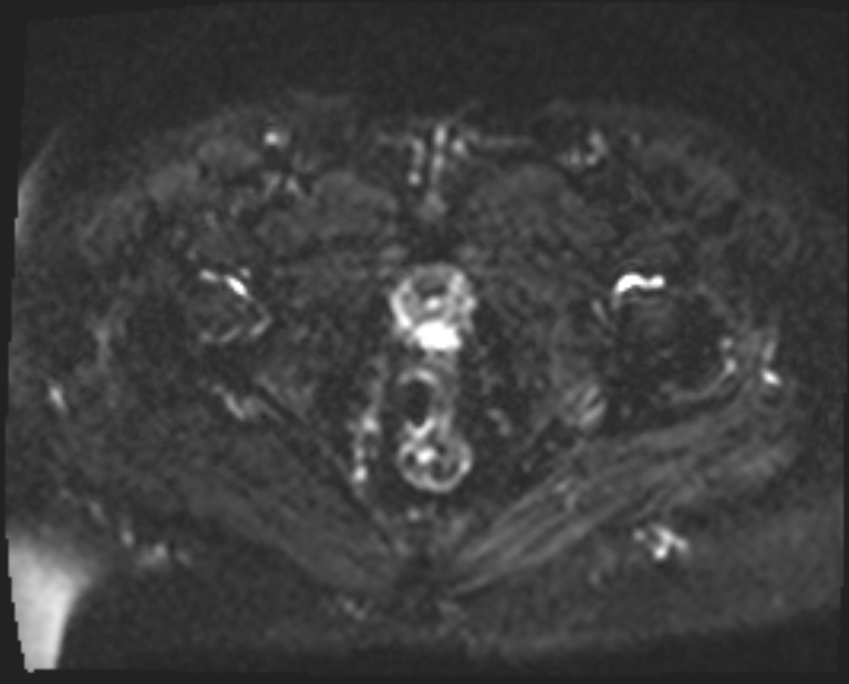 Cancer cervix - stage IIb (Radiopaedia 75411-86615 Axial DWI 5).jpg