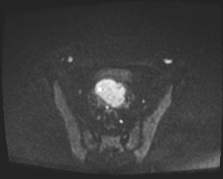 Cancer cervix - stage IIb (Radiopaedia 75411-86615 Axial DWI 77).jpg