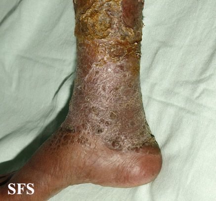 Candidiasis Chronic Mucocutaneos (Dermatology Atlas 23).jpg