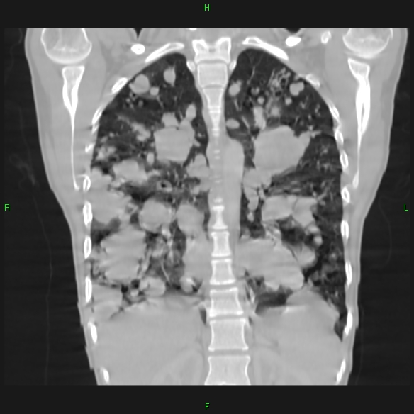 File:Cannon ball metastases - synovial sarcoma (Radiopaedia 26135-26271 Coronal lung window 13).jpg