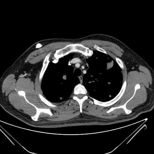 File:Cannonball pulmonary metastases (Radiopaedia 67684-77101 D 63).jpg