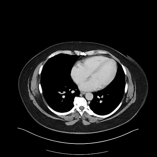 File:Carcinoid tumor - terminal ileum (Radiopaedia 60931-68739 A 2).jpg