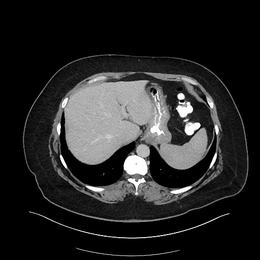 Carcinoid tumor - terminal ileum (Radiopaedia 60931-68739 A 23).jpg