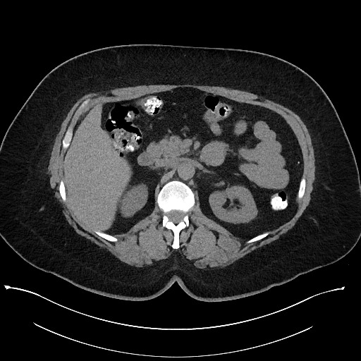 File:Carcinoid tumor - terminal ileum (Radiopaedia 60931-68740 Axial non-contrast 36).jpg