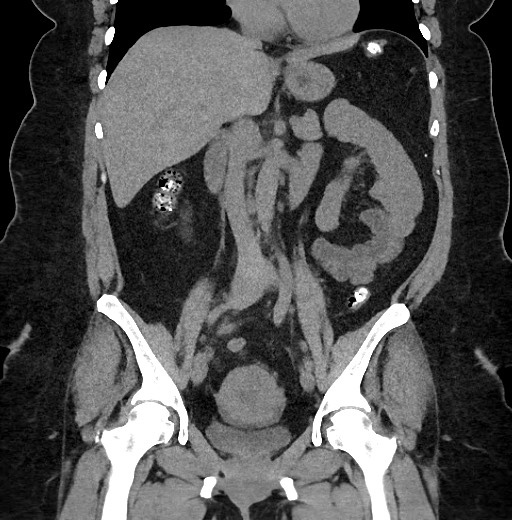 Carcinoid tumor - terminal ileum (Radiopaedia 60931-68740 Coronal non-contrast 52).jpg