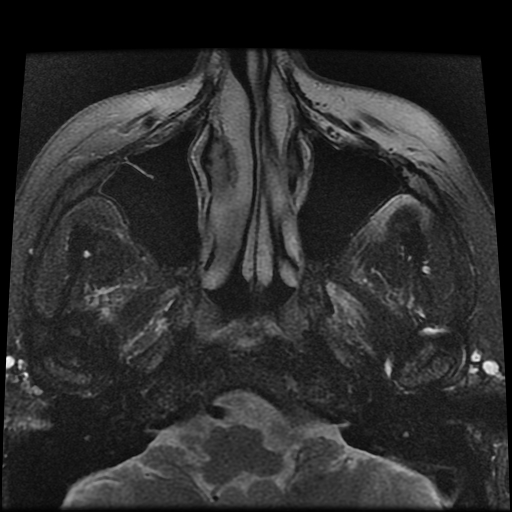 File:Carcinoid tumor of the ileum with metastasis to orbit (Radiopaedia 28165-28424 Axial T2 2).jpg