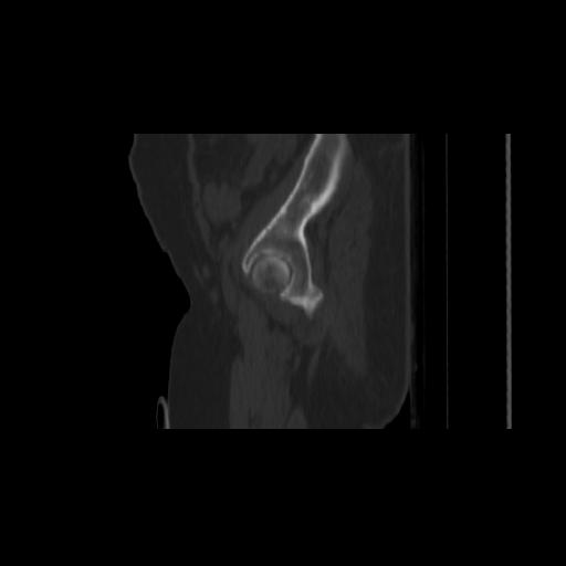 Carcinoma cervix- brachytherapy applicator (Radiopaedia 33135-34173 Sagittal bone window 17).jpg