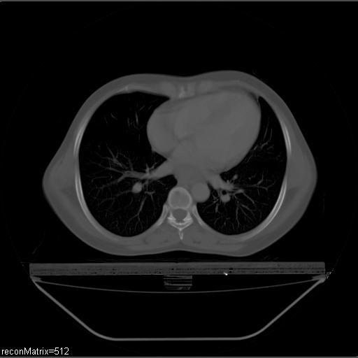 File:Carcinoma of esophagus (Radiopaedia 27356-27550 Axial bone window 15).jpg