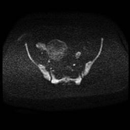 Carcinoma of the cervix (Radiopaedia 89018-105858 Axial DWI 79).jpg