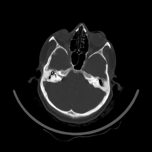 Carcinoma of the maxillary antrum (Radiopaedia 53805-59888 Axial bone window 27).jpg
