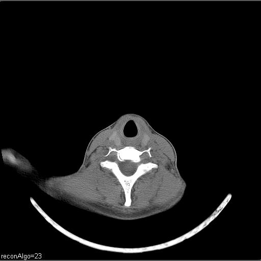 Carcinoma of the maxillary antrum (Radiopaedia 53805-59888 Axial non-contrast 20).jpg