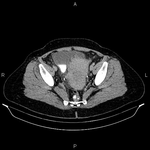 File:Carcinoma of uterine cervix (Radiopaedia 85861-101700 Axial C+ delayed 77).jpg