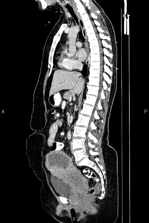 Carcinoma of uterine cervix (Radiopaedia 85861-101700 D 41).jpg