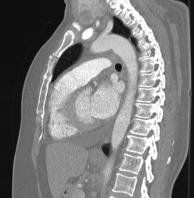 File:Cardiac sarcoidosis (Radiopaedia 74548-85534 Sagittal lung window 41).jpg