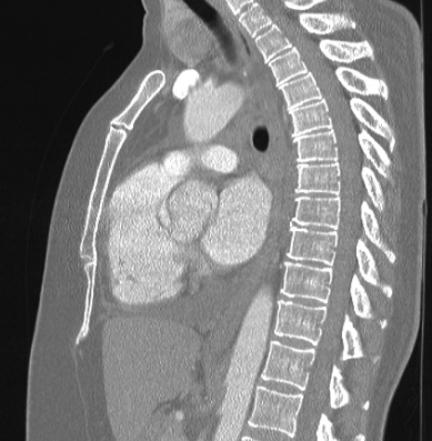 File:Cardiac sarcoidosis (Radiopaedia 74548-85534 Sagittal lung window 45).jpg