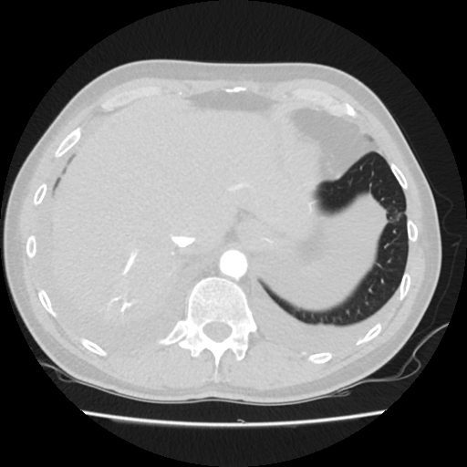 Cardiac tamponade (Radiopaedia 78607-91368 Axial lung window 83).jpg
