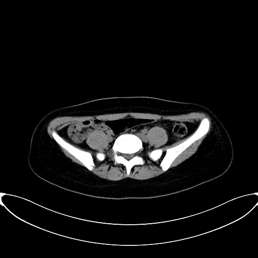 Caroli disease with medullary sponge kidney (Radiopaedia 82622-96804 Axial non-contrast 52).jpg