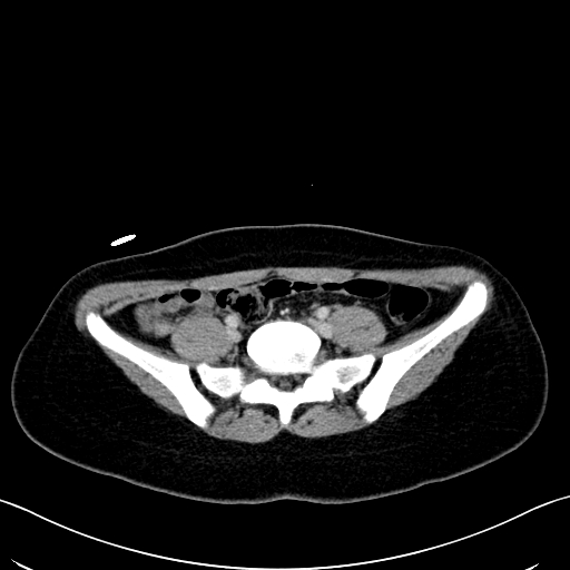 Caroli disease with medullary sponge kidney (Radiopaedia 82622-96804 C 53).jpg
